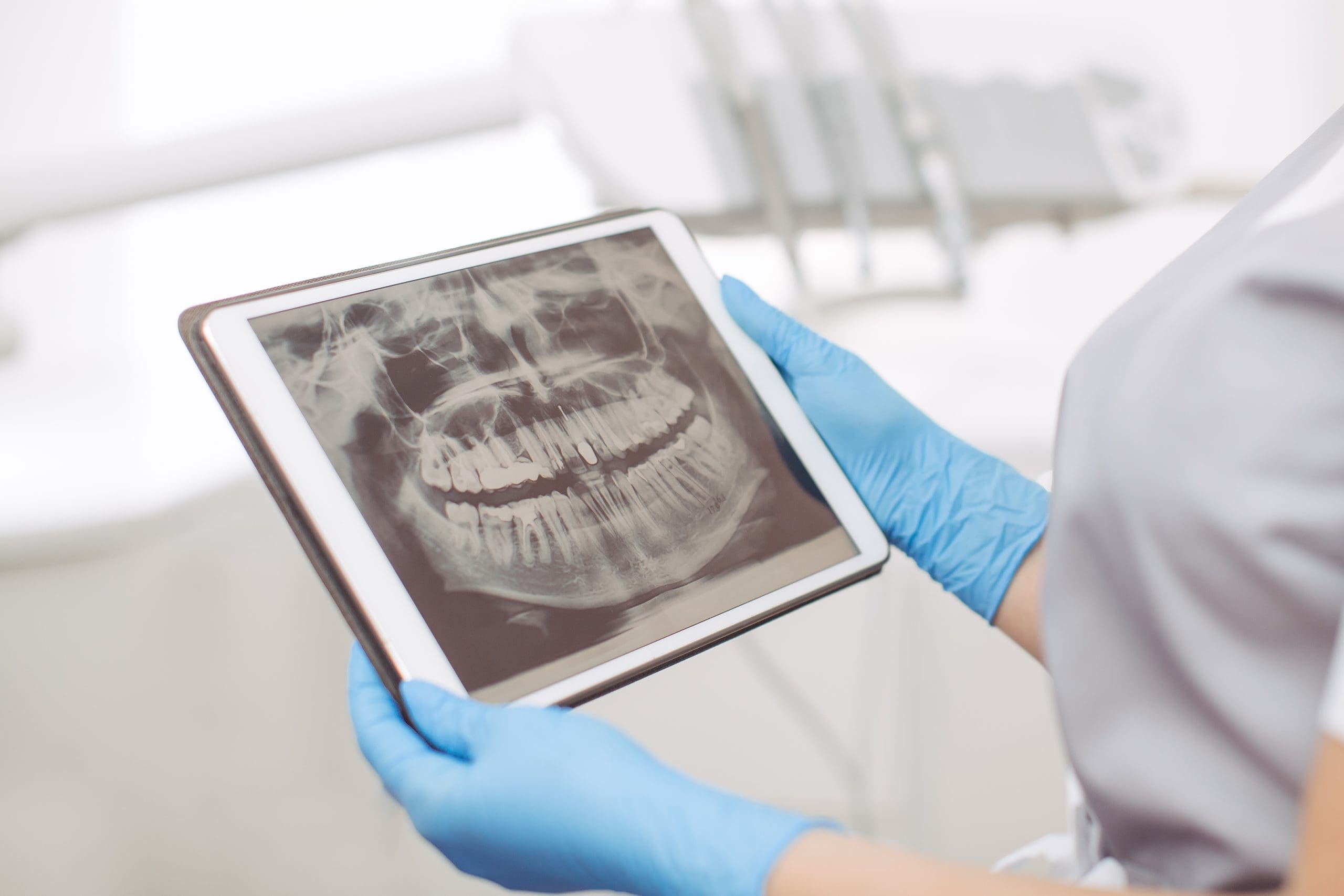 Dental X-rays cost: What to Know